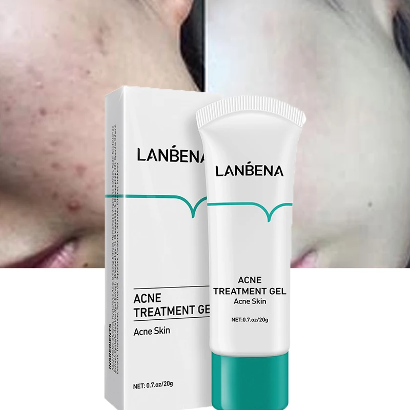 LANBENA Acne Treatment Face Cream Anti-acne Shrink Pores Oil Control Repair Skin Remove Pimple Whitening Moisturizing Skin Care 80 120 pieces lanbena blackhead papers face pores strips pad stickers skin care remover accessories household travelling