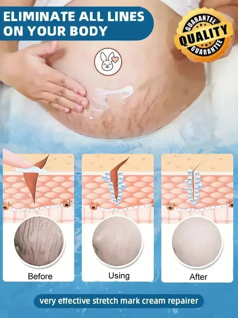 Eliminate Red White Old Stretch Marks Cream For Pregnancy Postpartum Skin Care Gel