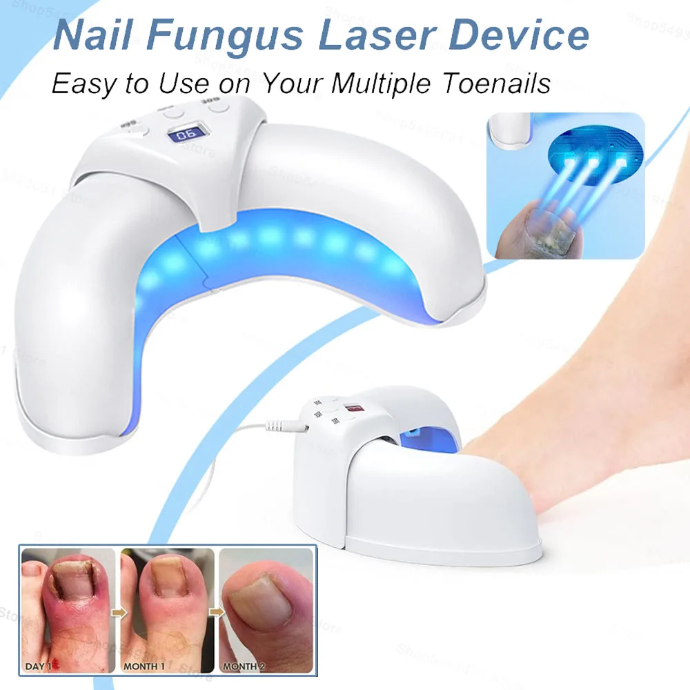 FungalNailLaserTreatmentRepairFastNailsFungusOnychomycosis