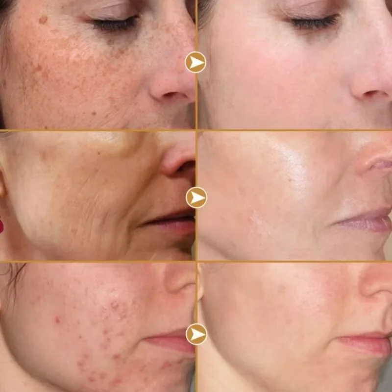Nicotinamide Whitening Freckles Serum Face Dark Spot Remover Vitamin C Lightening Melanin Blemish Moisturizer Brighten Skin Care 3
