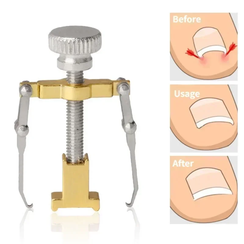 Ingrown Toenail Corrector Straightening Clip Pedicure Foot Nail Care Tools Stainless Steel Pedicure Treatment Onyxis Correction 2