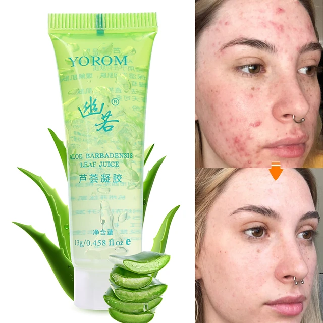 gennemførlig uld Vant til Aloe Vera Acne Scar Removal Cream Acne Spots Burn Gel Surgical Scar  Treatment Moisturizing Whitening Scar Removal Gel Skin Care - Day Creams &  Moisturizers - AliExpress