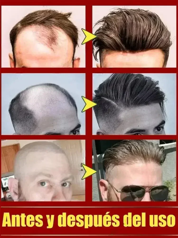 Hair Treatment Hot selling product, 99% of buyers buy again, have more and more hair, say goodbye to baldness, thick hair