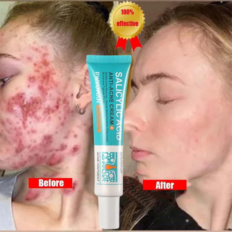 7 Days Acne Removal Cream Blackheads Salicylic Acid Treatment Cream Oil Control Pore Shrinkage Moisturizing  Whitening Skin Care