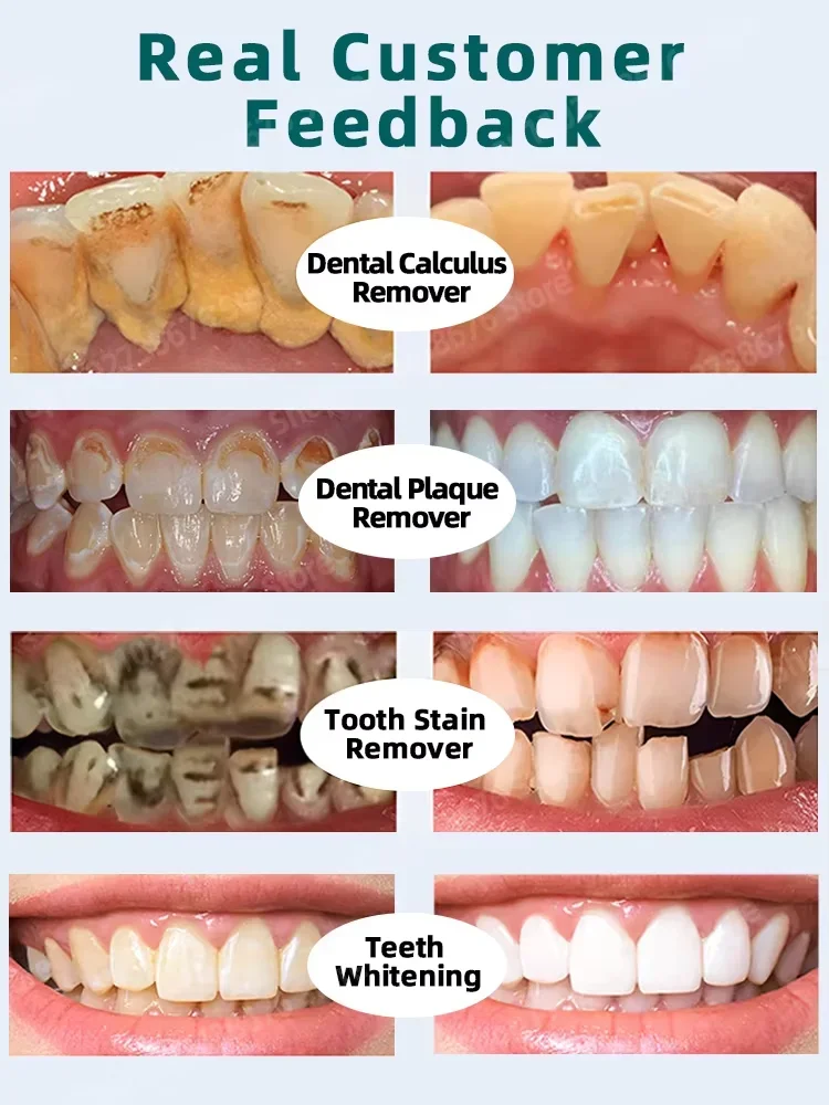 Whiter Teeth, Confident Smile