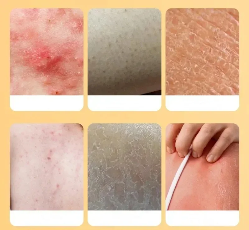 320ml Sulfur Liquid Mite Removal Soap-Deep Cleansing Shower Gel for Whole Body Acne Treatment-Body Wash for Deep Cleaning