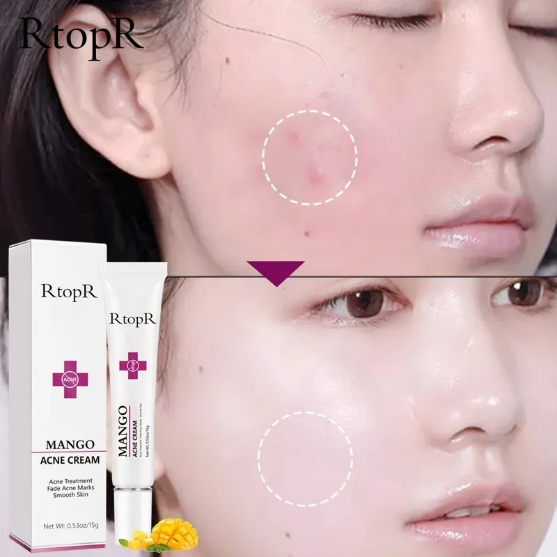 

Акне лечение крем для лица прыщи восстановление масла контроль сужение поры шрам увлажняющий крем уход за кожей Корейская косметика отбеливающий крем