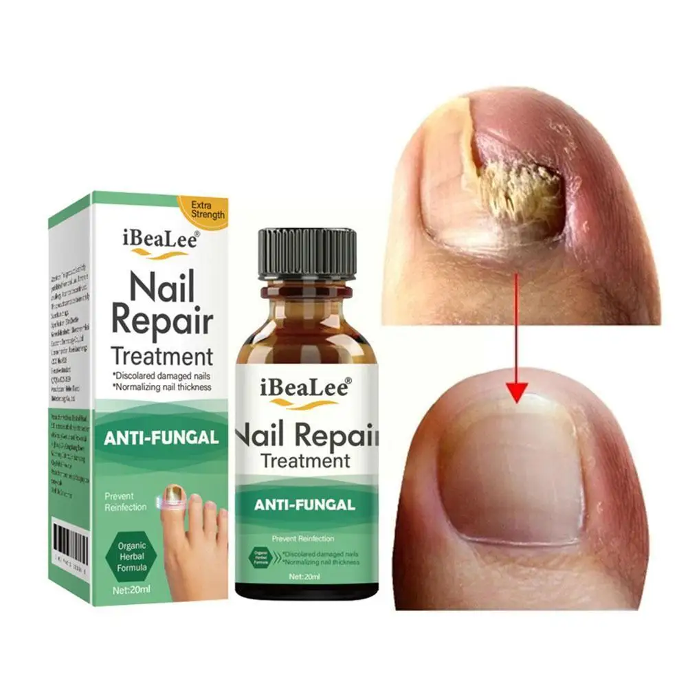

Feet Care Essence Nail Fungus Removal Oils Nail Fungal Removal Infection Toe Anti Oil Fungus Foot Hand Treatment Repair H3E9