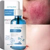 Repair Facial Redness Serum Instant Spider Vein Remove Sensitive Skin Sooth Anti Redness Rosacea Treat Lotion Korean Cosmetics 1