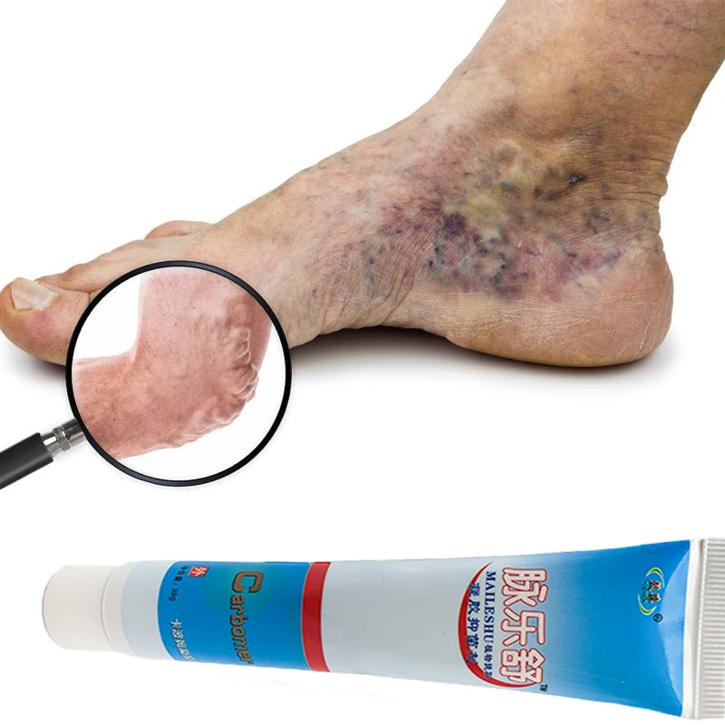 

Крем для лечения варикозного расширения вен, 30 г, средство для удаления варикозного расширения вен в форме паутины ног и ног, медицинский пластырь