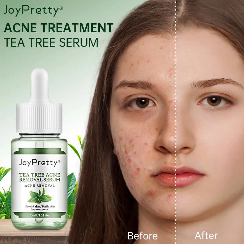 JoyPretty Acne Treatment Face Serum Tea Tree Oil Essence Moisturizing