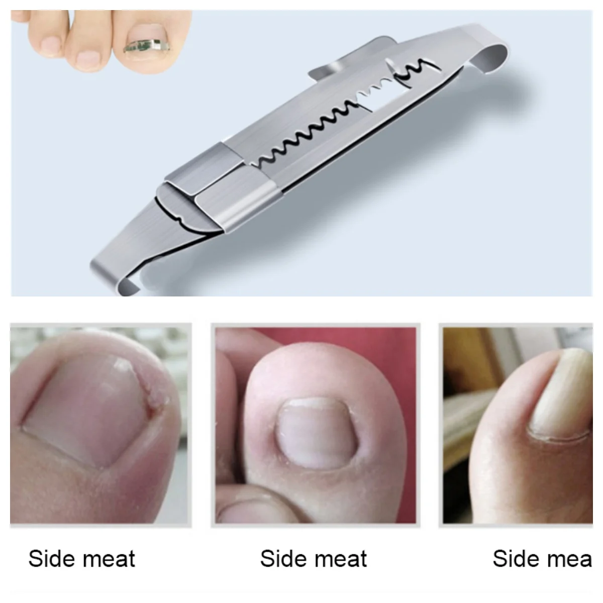 

Toe Separator Pedicure Tool Ingrown Toe Nail Correction Tool Effective Patch Tool Innovative Straightening Clip 발가락 교정기