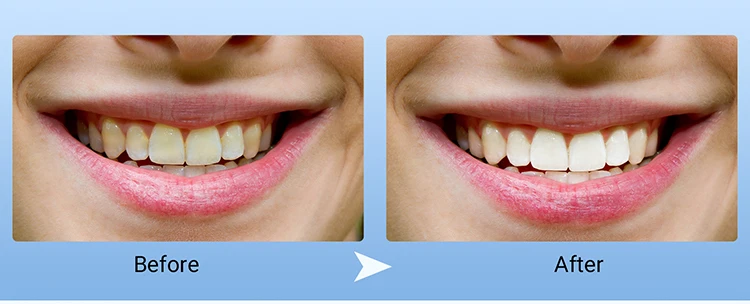 50 Stück Harz-Dentalprovisional Veneers A1/A2 Shade Ultradünne temporäre Kronen für obere vordere und vordere und backenzähne AZDENT – Detail 14