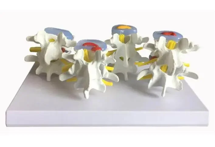 

lumbar vertebrae degeneratation advanced osteoporosis spinal skeleton model