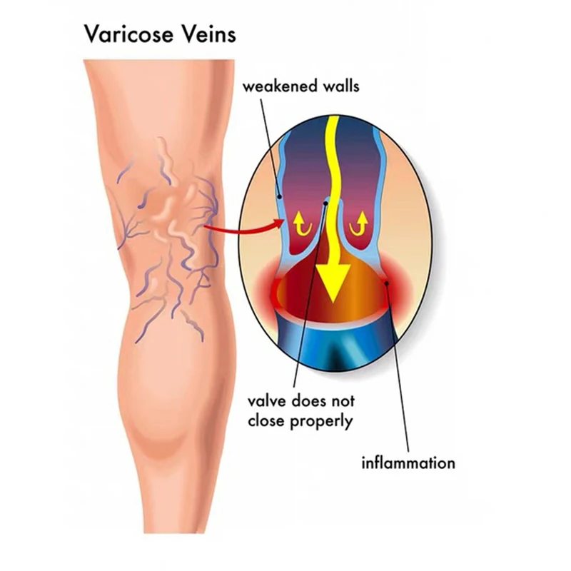 Varicocele Therapy Light Lamp 3