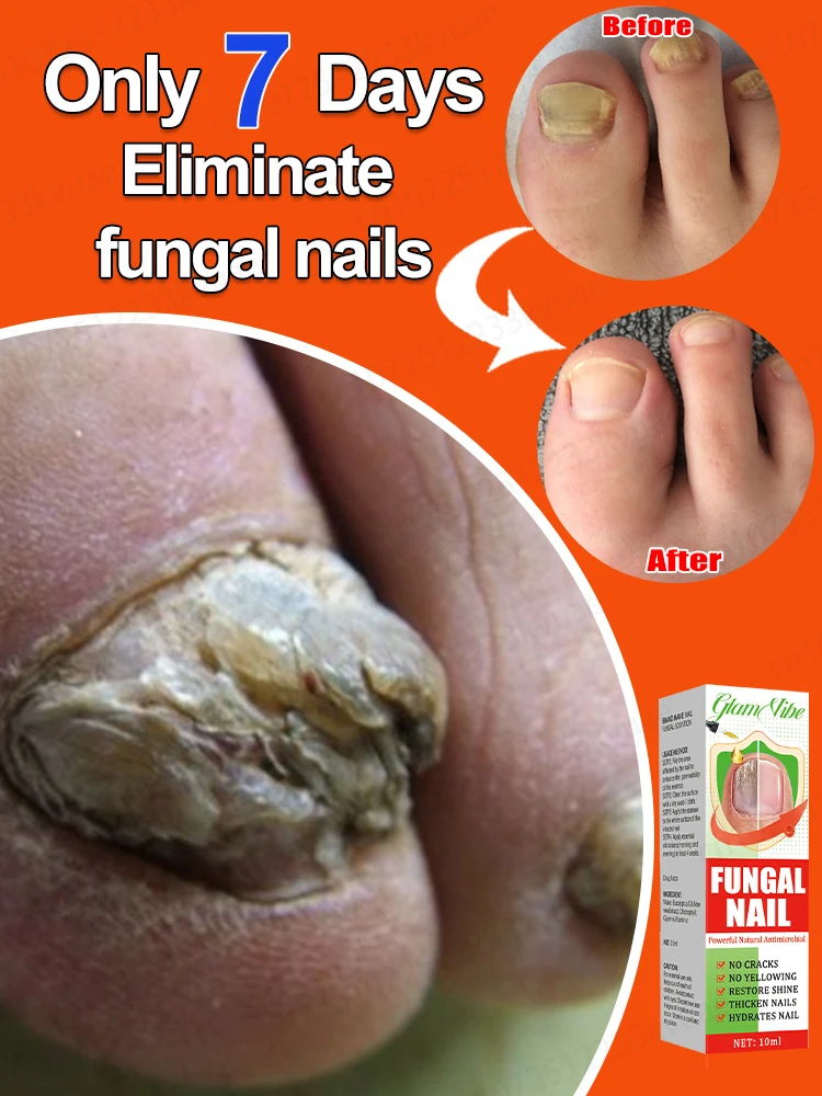 Nail fungus treatment essential oil repair onychomycosis in 7 days