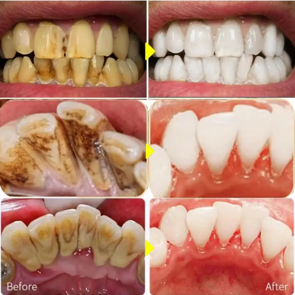 Dental Calculus Remover Teeth Whitening Spray Toothpaste Cleaning Oral Hygiene Removal Halitosis Plaque Stains Fresh Breath Care dental calculus remover