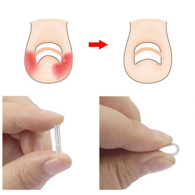 alt="A set of 10 Ingrown Toenail Corrector Patches, ranging from 13-20mm.