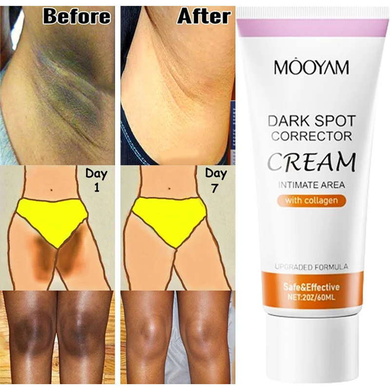 

Underarm Bleaching Cream Private Parts Melanin Remover Lotion Armpit Knees Elbows Dark Spot Corrector Moisturizing Brighten Body