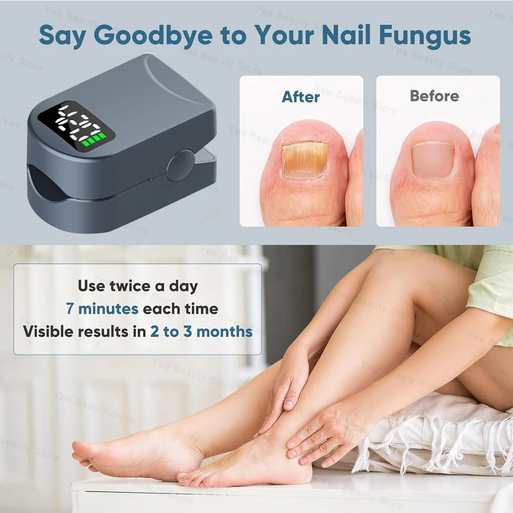 Nail Fungus Treatment Laser Device for Cleaning Onychomycosis Anti Fungal Repair Toenail Fingernail Foot Care Tools