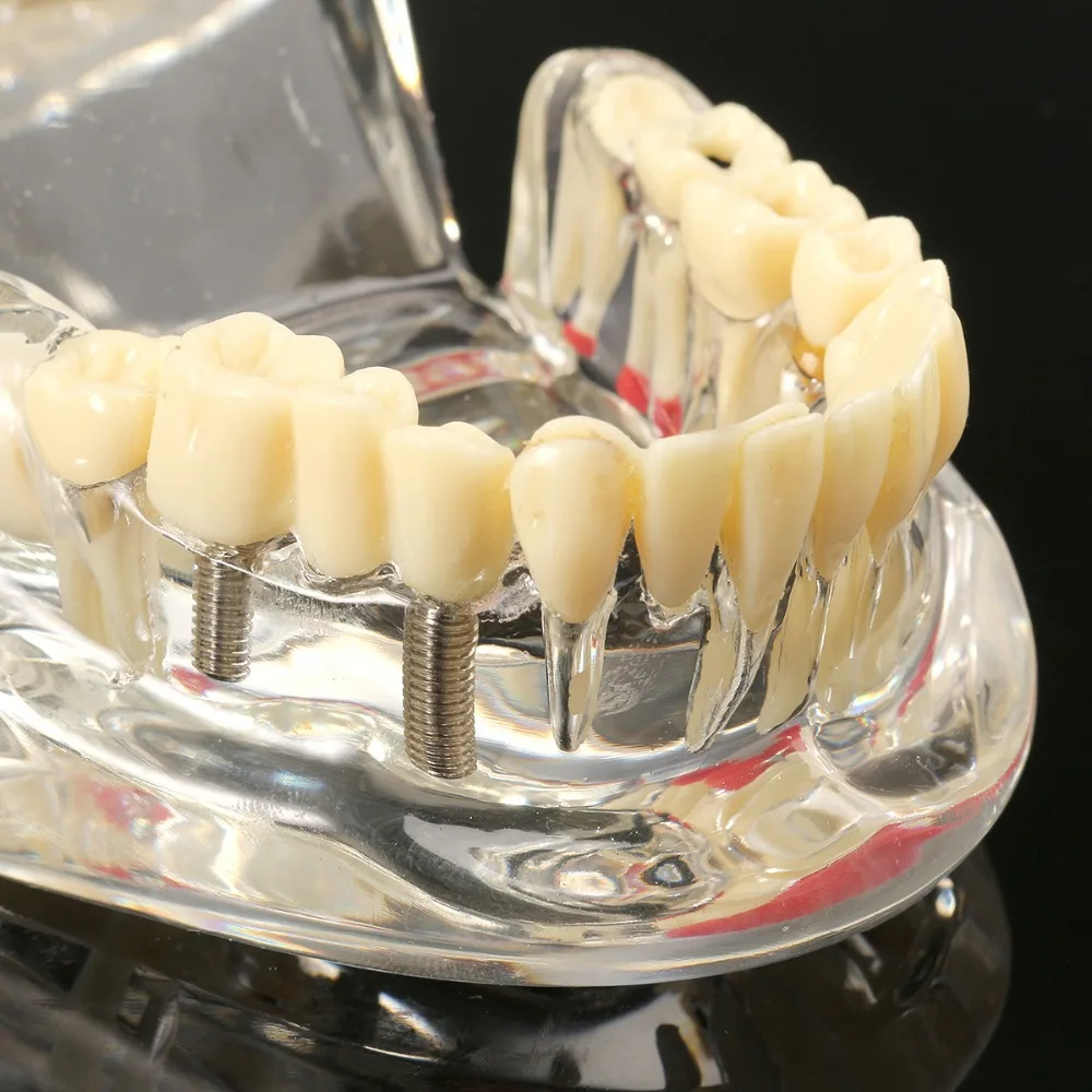 Dental Implant Resin Model for Dental Disease Education and Research