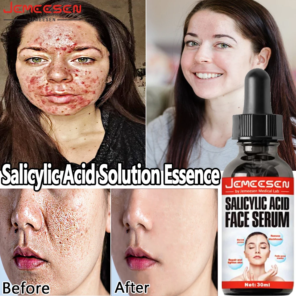Jemeesen Salicylic Acid Solution Essence Shrink Pores Acne Removal Oil
