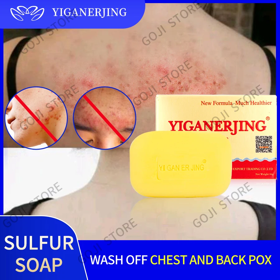 Yiganerjing Sulfur Soap Psoriasis Eczema Ointment Acne Seborrhea