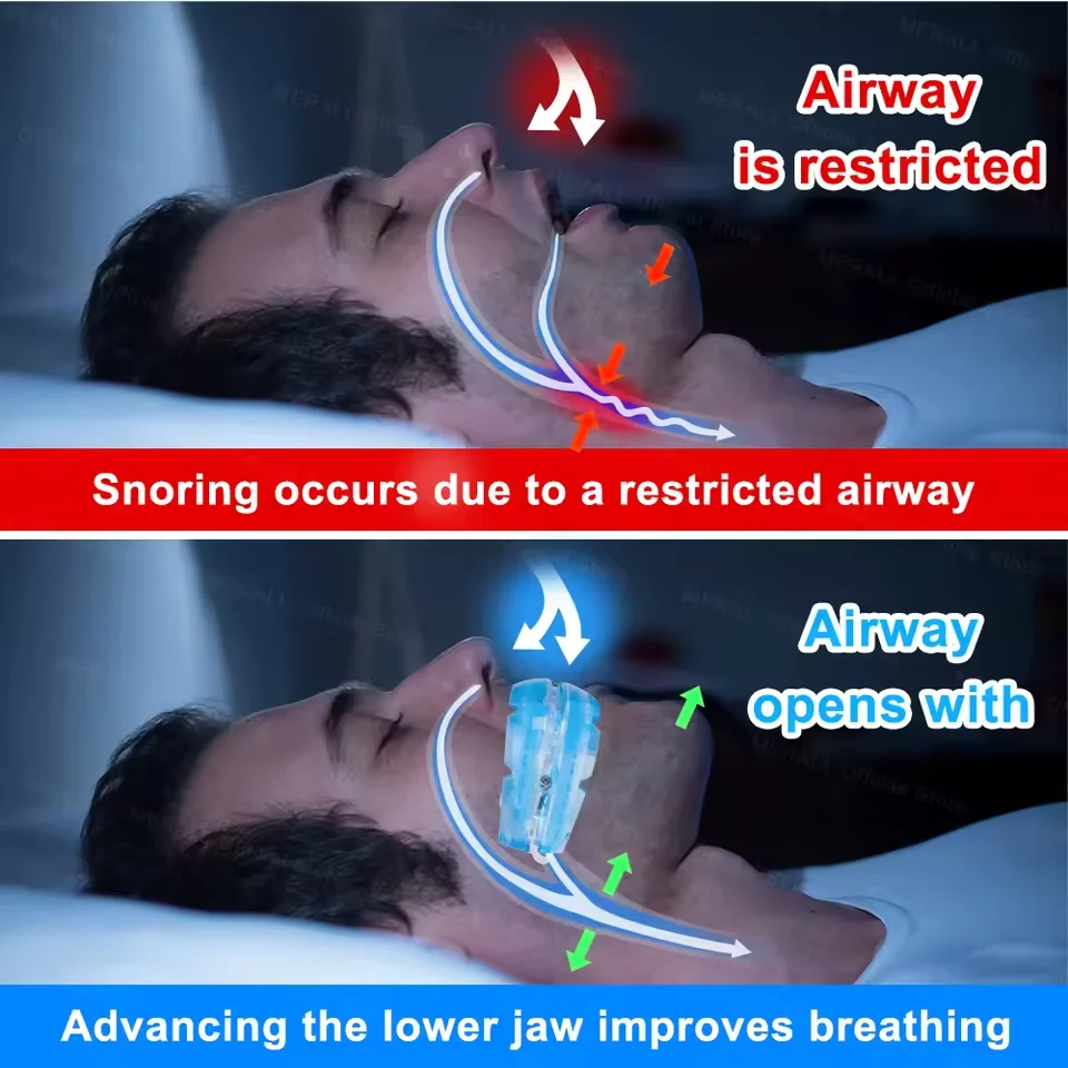 Mouth Guard Anti Snoring Soft Mouthpiece Comfortable Snoring Solution Adjustable Night Sleep Aid Bruxism Mouthpiece 2