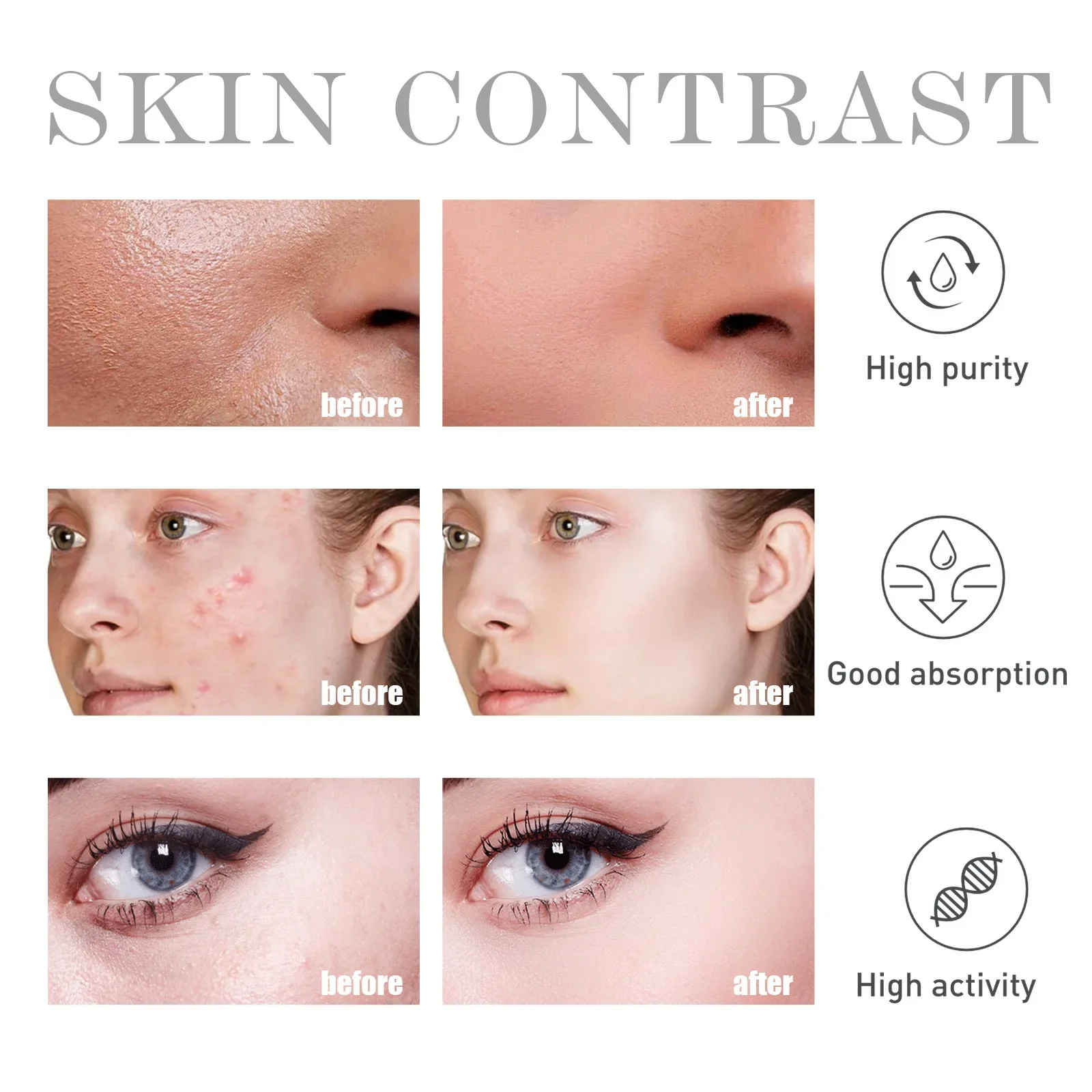 Tratamento de acne soro comum ácido salicílico soros remover espinhas cravos anti acne poros encolher essência de rejuvenescimento da pele_voghion.com