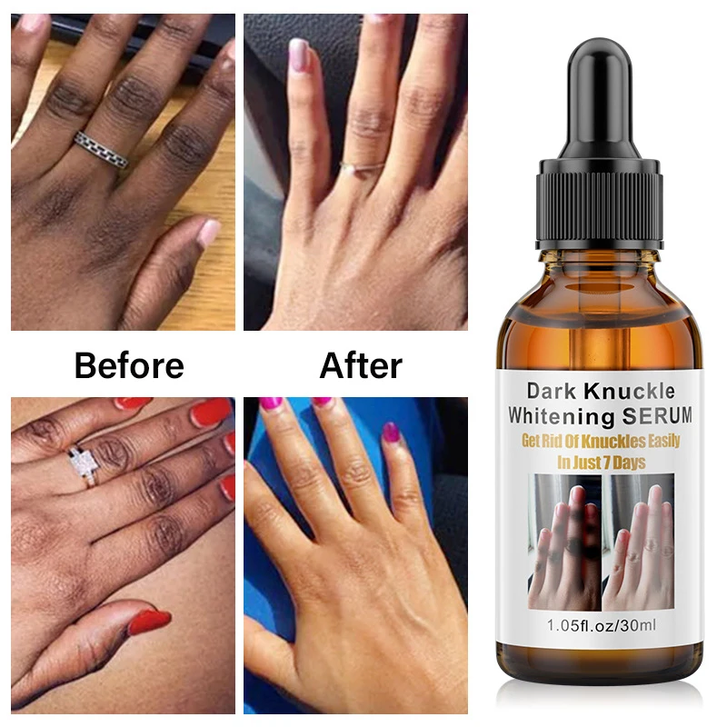 Dark Knuckles Fast Brighten Serum Elbows Hand Knuckle Brightening Serum Knee Black Skin Quickly Lighten Stains Remover Essence,facial serum,facial essence