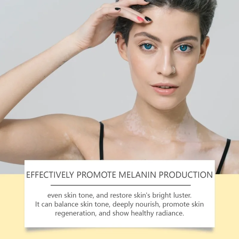 Bee Venom Vitiligo Treatment Cream Eliminate Vitiligo Sweat Spot Antibacterial Mycosis Leukoplakia Cure Moisturizes Care Cream vitiligo ointment