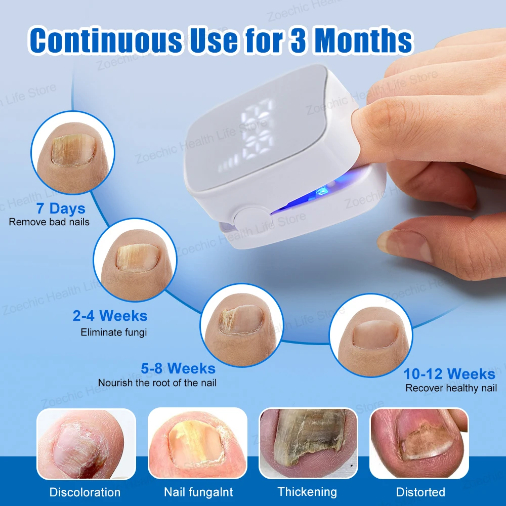 Time Display Fungal Nail Treatment Laser Device Foot Nail Repair Patch Toenail Laser Therapy Machine Ingrown Toenails Foot Care