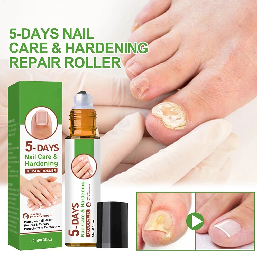 Toenail Laser Nail Fungus Treatment Laser Pen Anti Fungus Infection Fungal Remove Dispel Leuconychia Liquid Onychomycosis Grow