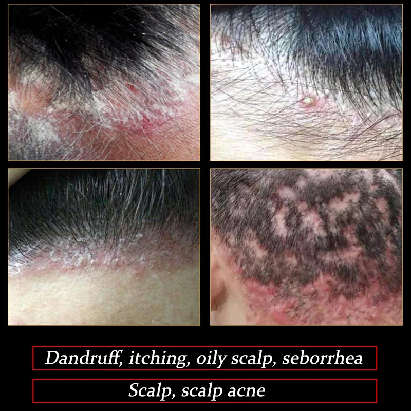 200mlHairPsoriasisSeborrheicSkinCareTreatmentDermatitisEczema