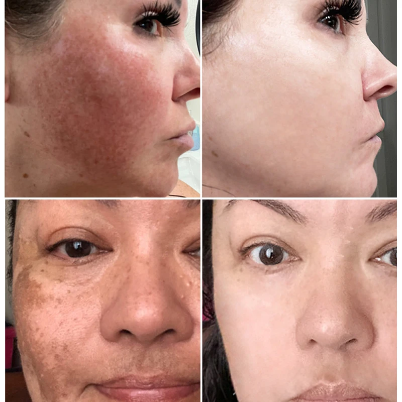 Facial Serum Whitening Serum Vitamin C Skin Brighten Essence Removal Melasma Dark Spots