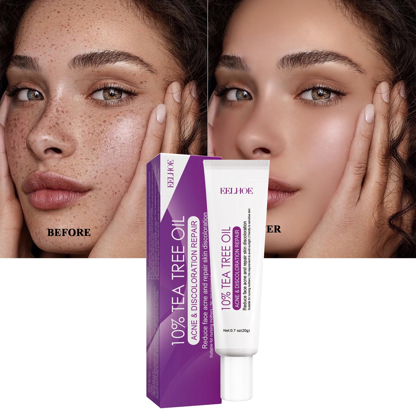 

Freckle Whitening Cream Acne Treatment Fade Acne Spots Oil Control Remove Dark Spot Melasma Anti-Pigmentation Brighten Skin Care