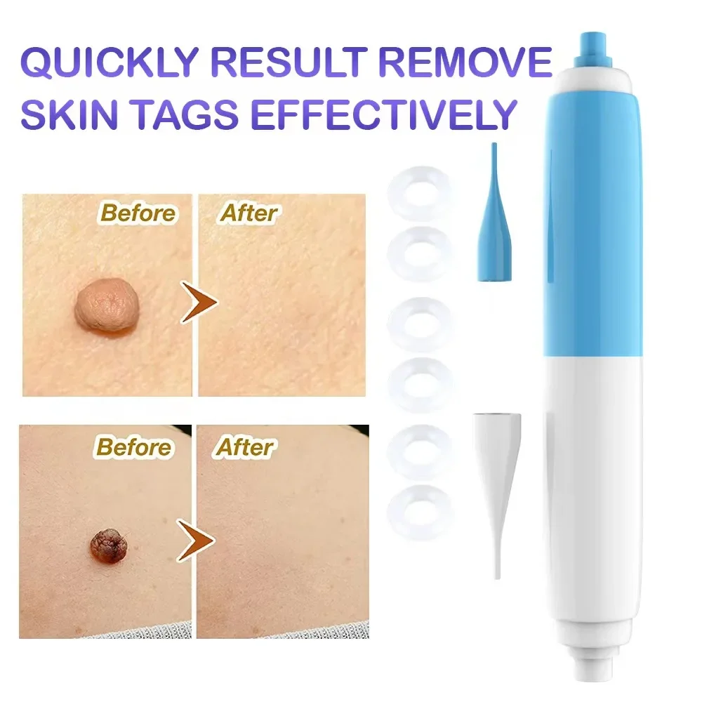 2 In1 Painless Auto Skin Tag Mole Wart Removal Kit Cleaning Tools Face Skin Care Body Wart Dot Treatments Remover Beauty Health