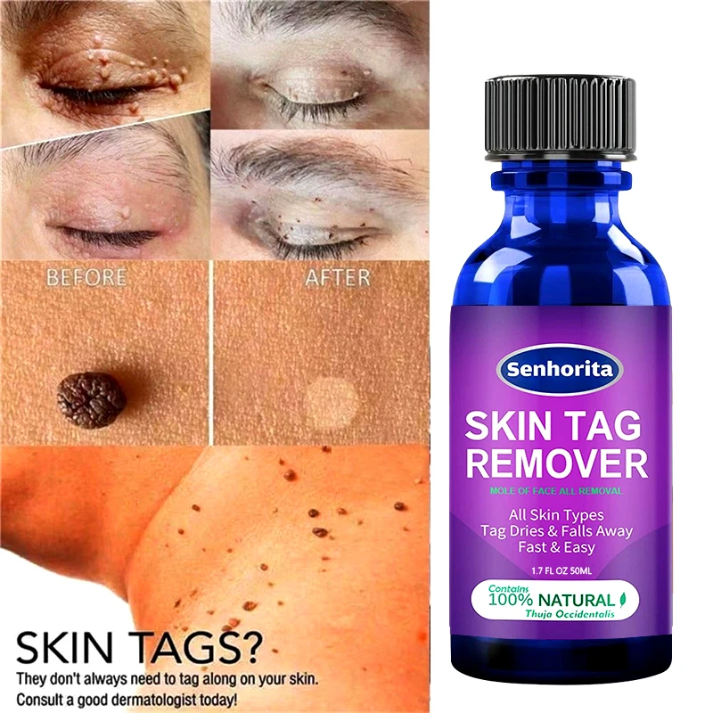 Skin Tag Remover Against Mole & Genital Wart Fast Removwithin Al Anti ...