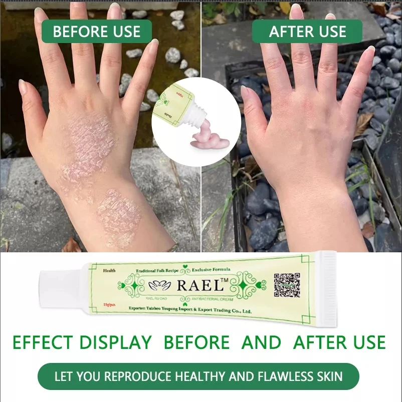 Psoriasis Ointment YIGANERJING RAEL Original Powerful Professional 5Pcs Native Medicine Ingredient Security