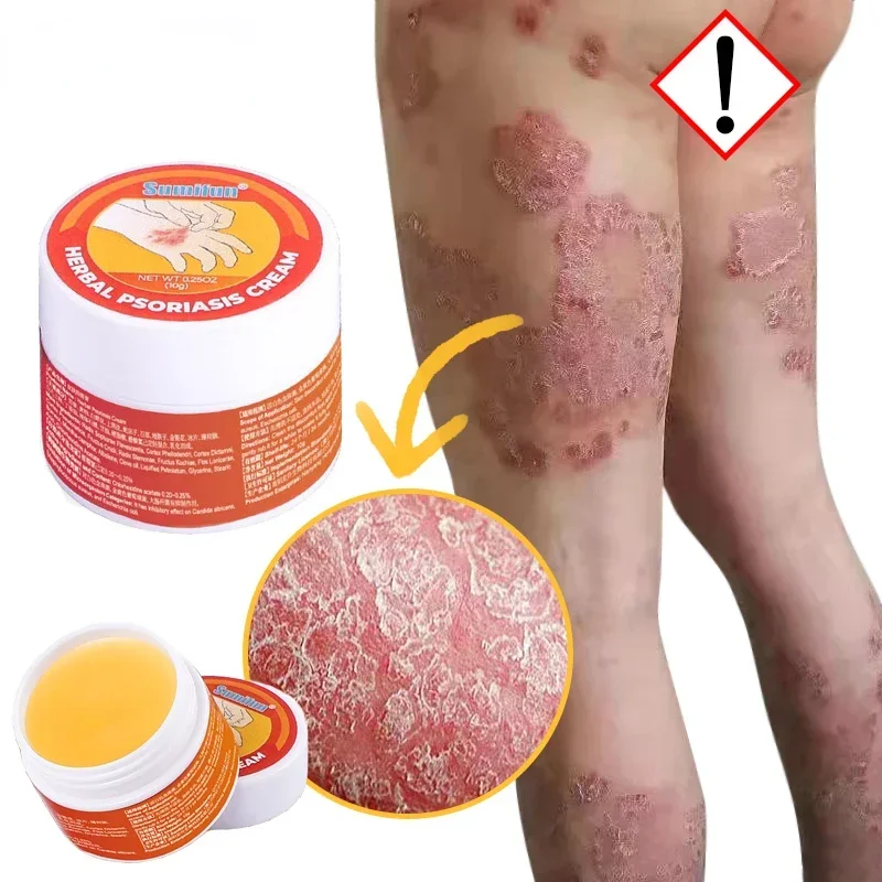 Herbal Skin Cream for Psoriasis Dermatitis