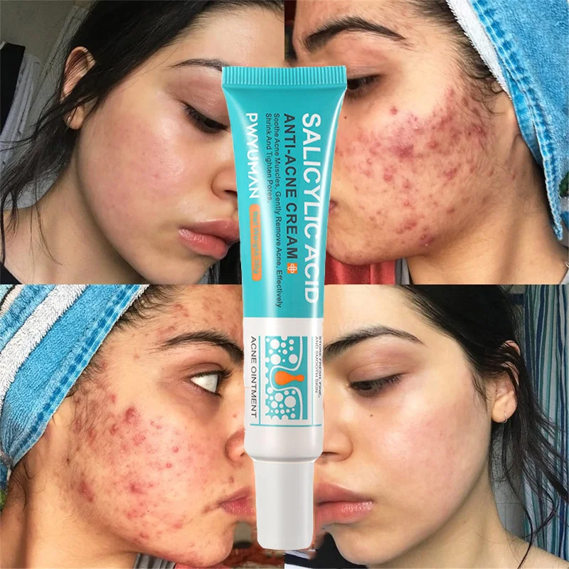 

Salicylic Acid Acne Treatment Cream Anti Acne Oil Control Fade Fine Lines Removal Pimples Spots Shrinking Pores Repair Skin Care