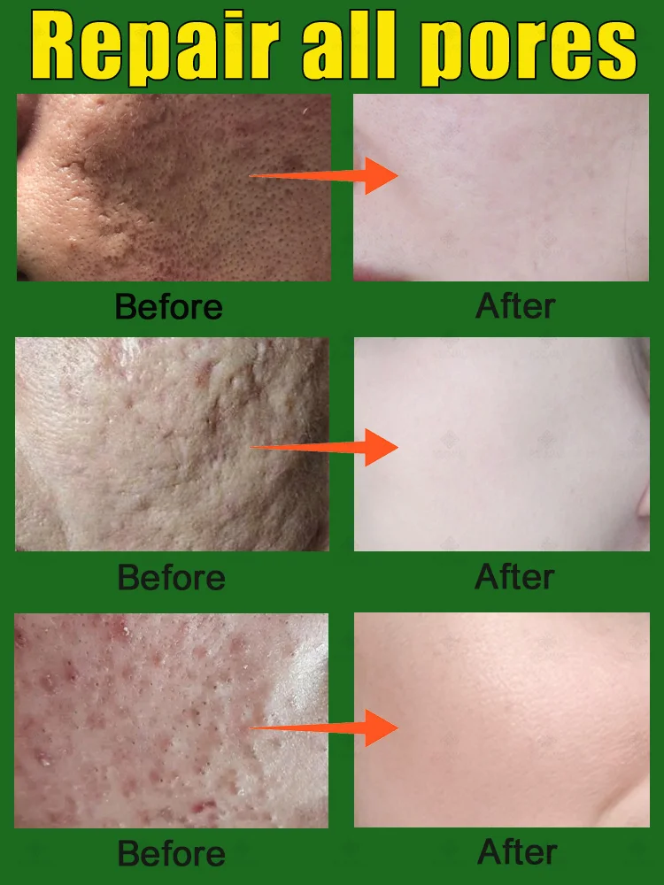 Plant extract facial pore essence Improves large pores Whitens and brightens skin Moisturizes skin