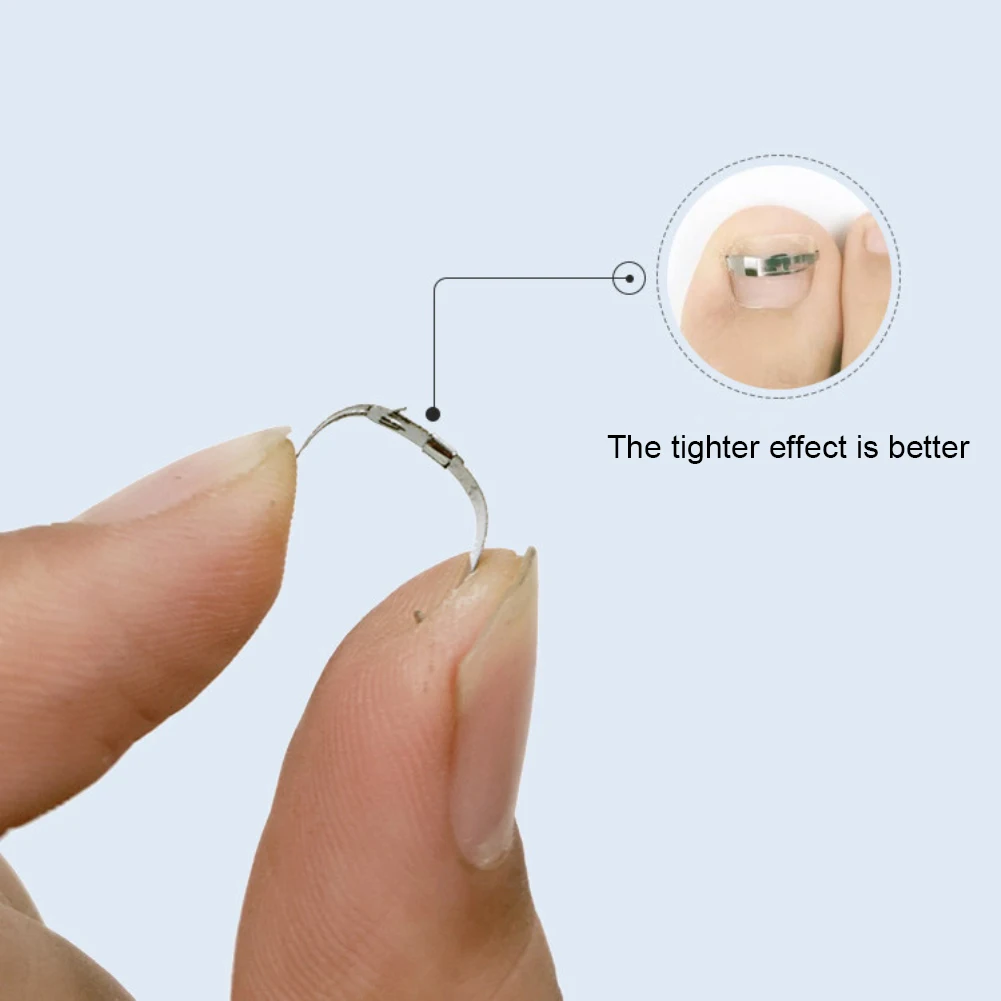 Ingrown Toenail Correction Tool Ingrown Toe Nail Correction Tool Patch