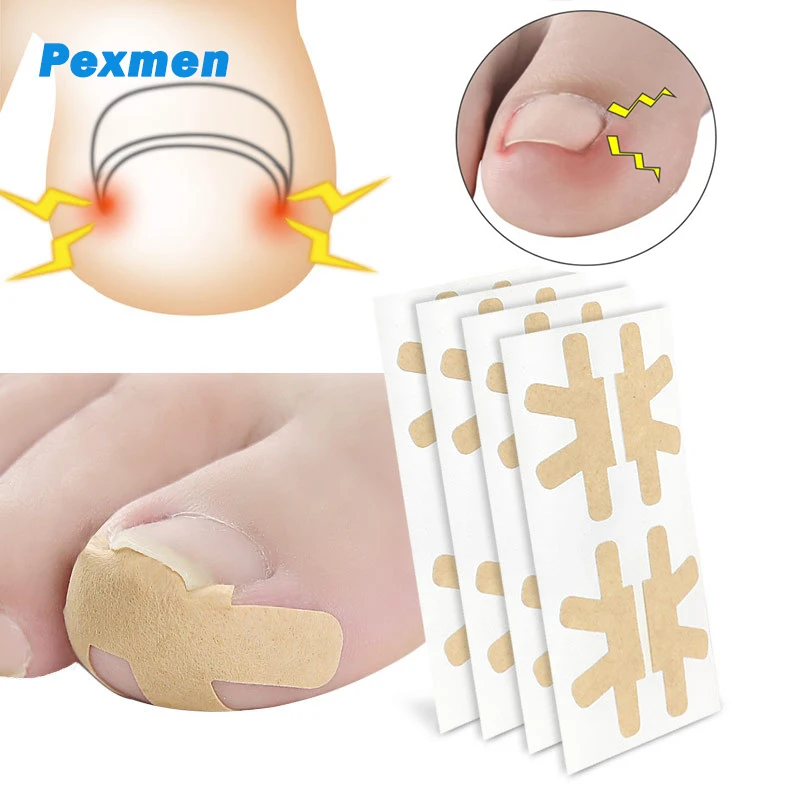 Pexmen 4/8/20Pcs Ingrown Toenail Correction Sticker Adhesive Toenail Patch Elastic Nail Treatment Corrector Sticker 1sheet fashion marble nail sticker decals self adhesive toenail art polish tips nail wraps strips easy toenail sticker foil