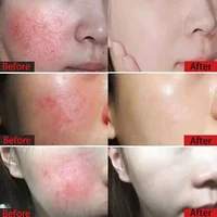 Crème réparatrice pour les rougeurs du visage, améliore la sécheresse des peaux sensibles, Lotion apaisante hydratante, élimination de la rosacea, cosmétiques coréens de jour et de nuit 2
