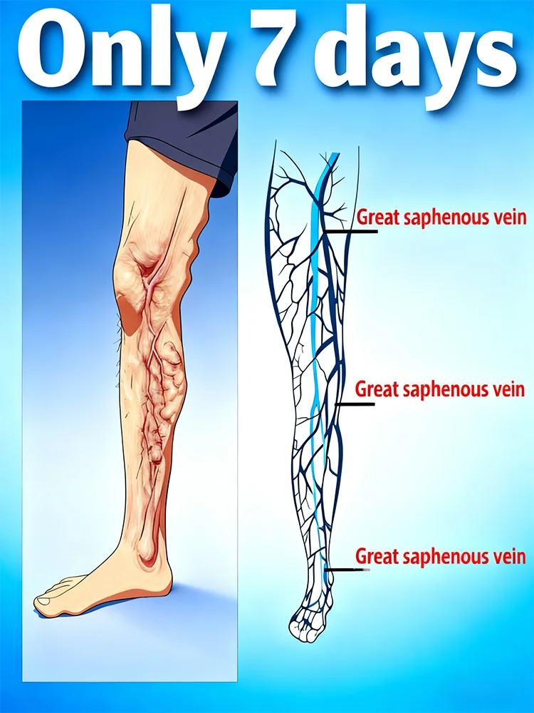 2025 New upgraded laser remove spider legs and varicose veins in 7 days