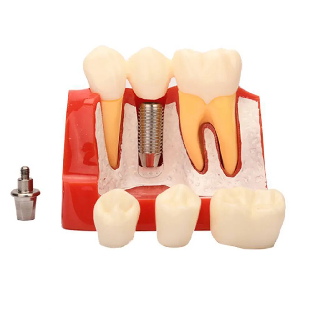 

4 Times Dental Implant Model Analysis Crown Bridge Demonstration Denture Mold Dentistry Clinic Teaching False Teeth Removable