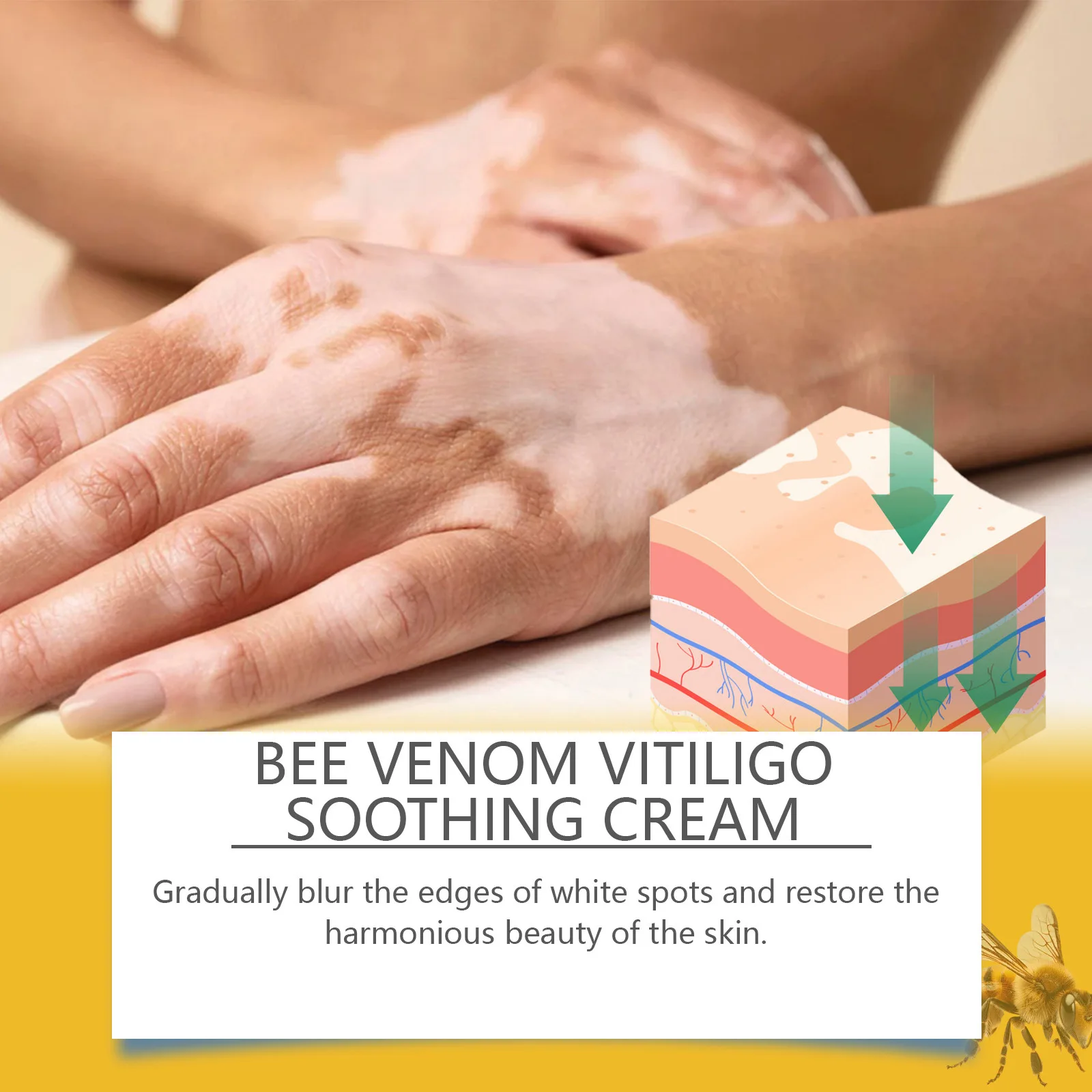 Bee Venom Vitiligo Soothing Cream Reament Repair Leukoplakia Reduce Pigment Melanin Antibacterial Moisturing Skin Care Cream