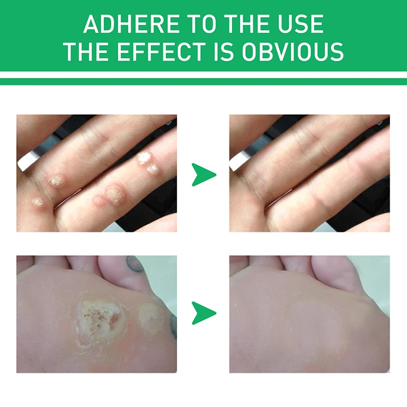 10ml Remove Foot Corn Care Cream Remove Foot Calluses Remove Warts