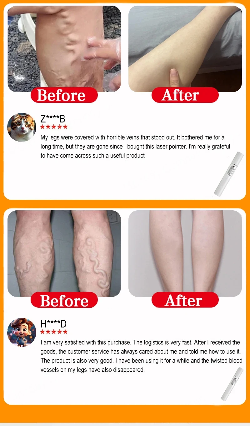 Varicose Vein Lampshade Therapy Effective Relief Of Dilated Vasculitis In The Legs Phlebitis Improved Blood Circulation New 4